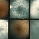 Harada's Disease Harada's Disease